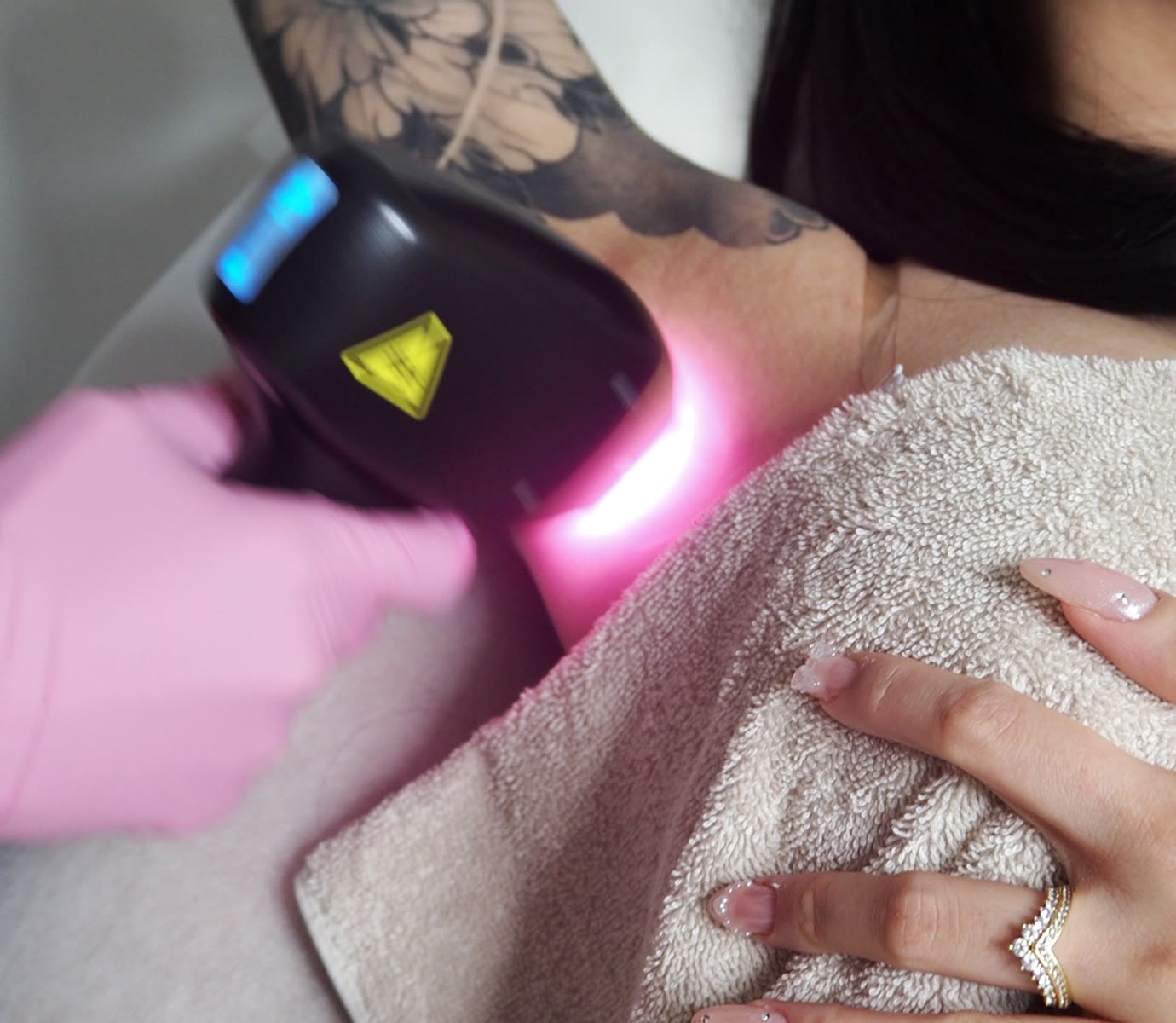 Laser hårborttagning behandling